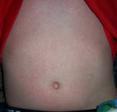 What are the symptoms of a streptococcus rash?